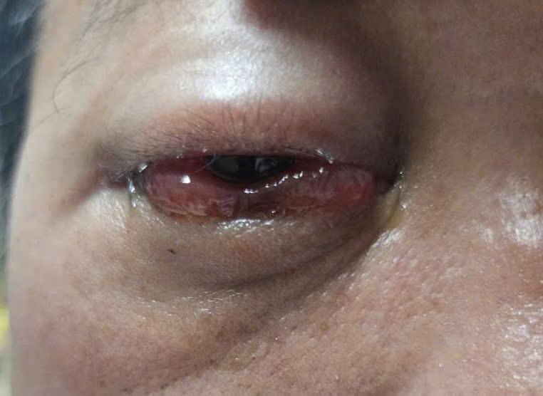 Bệnh viện Quân y 121 làm chủ kỹ thuật nút rò động mạch cảnh xoang hang Bệnh viện Quân y 121 làm chủ kỹ thuật nút rò động mạch cảnh xoang hang