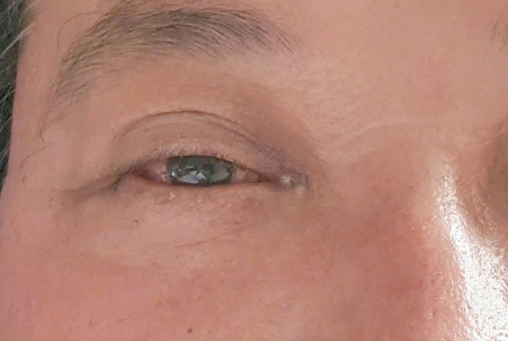 Bệnh viện Quân y 121 làm chủ kỹ thuật nút rò động mạch cảnh xoang hang Bệnh viện Quân y 121 làm chủ kỹ thuật nút rò động mạch cảnh xoang hang