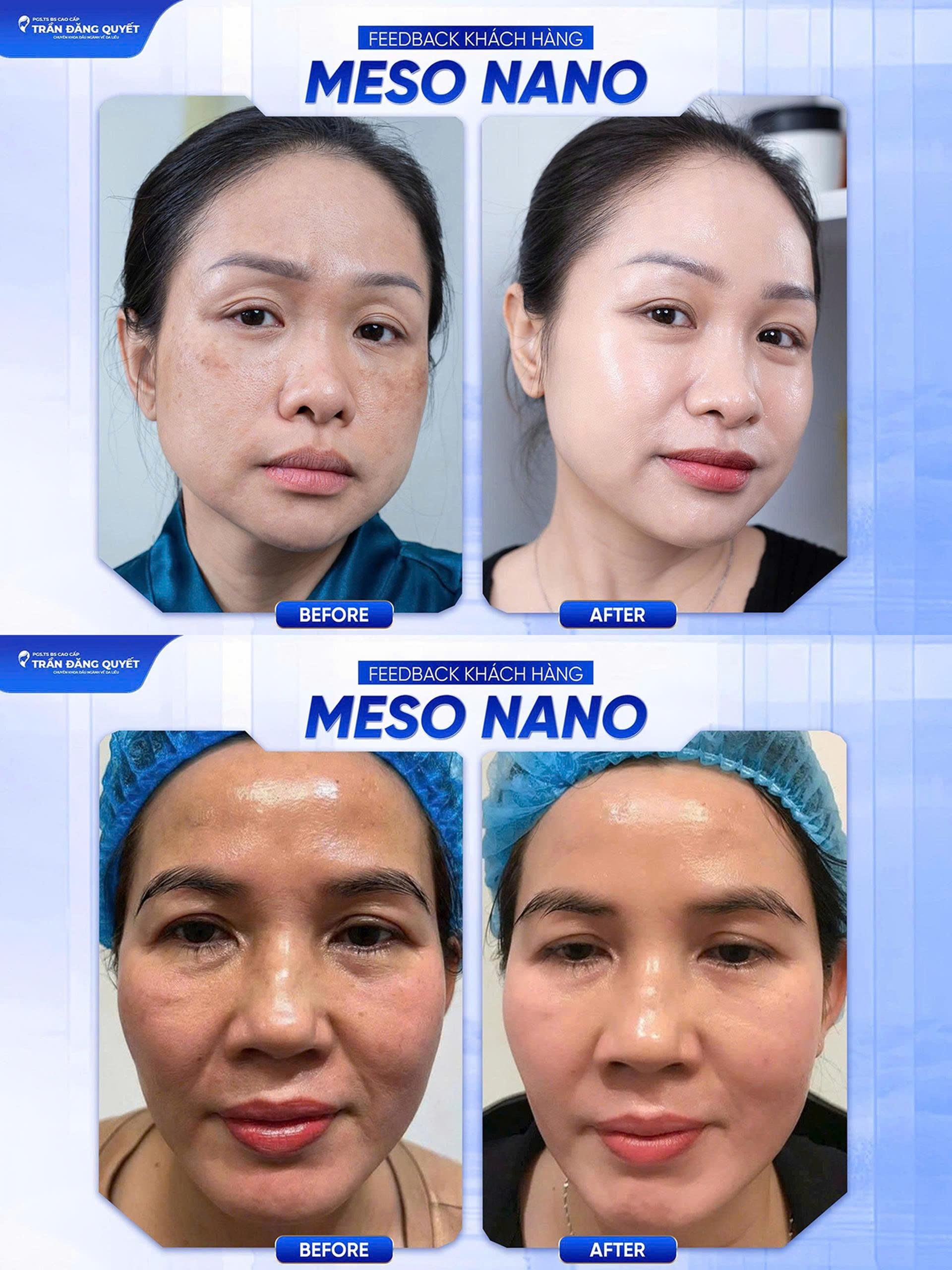 Hiệu quả điều trị nám và trẻ hoá da bằng phương pháp Meso Nano kết hợp CNC