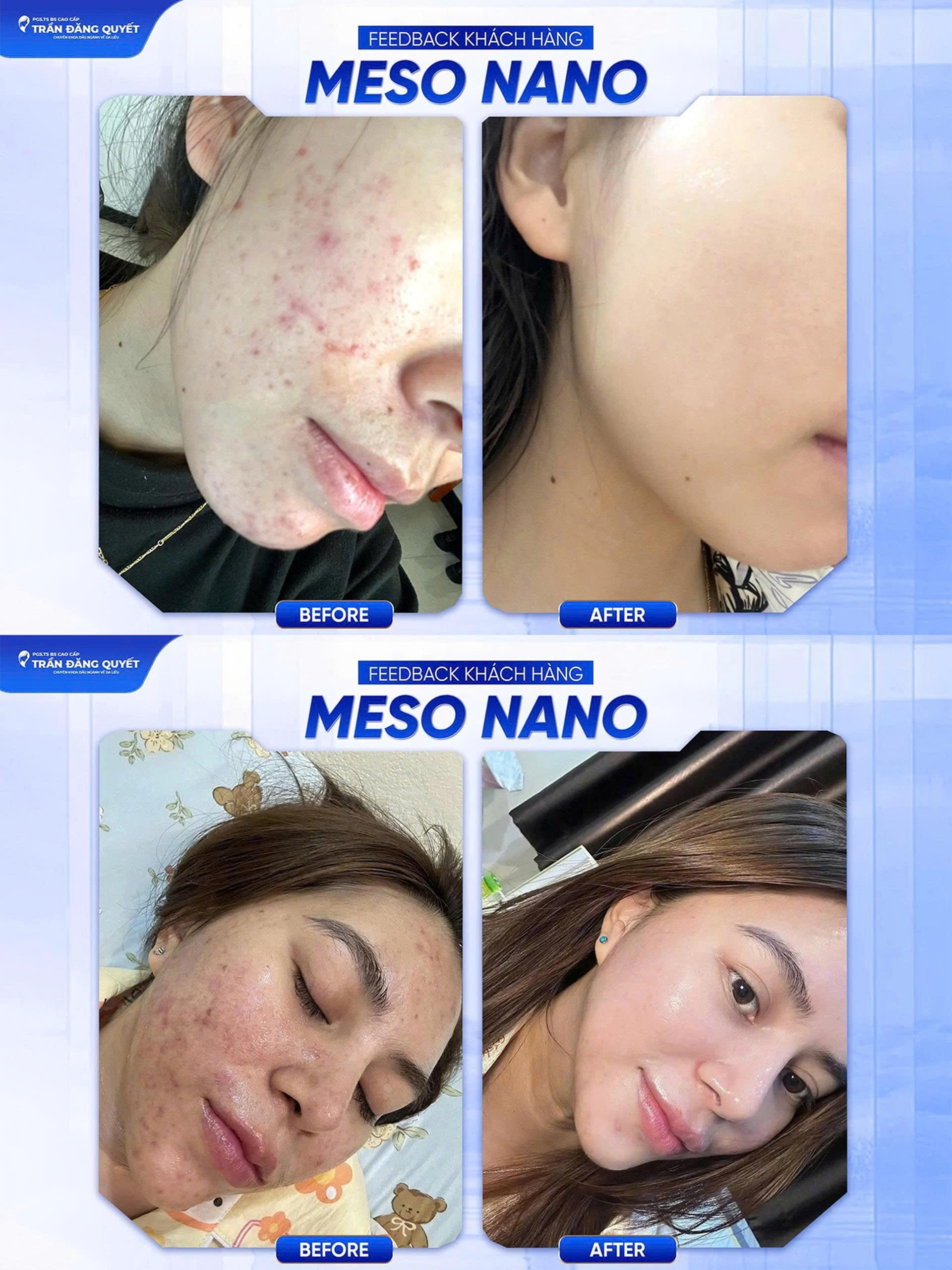 Hiệu quả điều trị mụn và sẹo bằng phương pháp Meso Nano kết hợp CNC